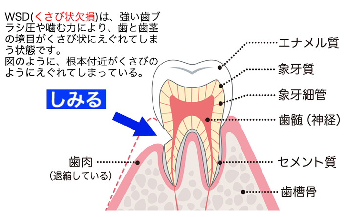 歯科 wsd とは